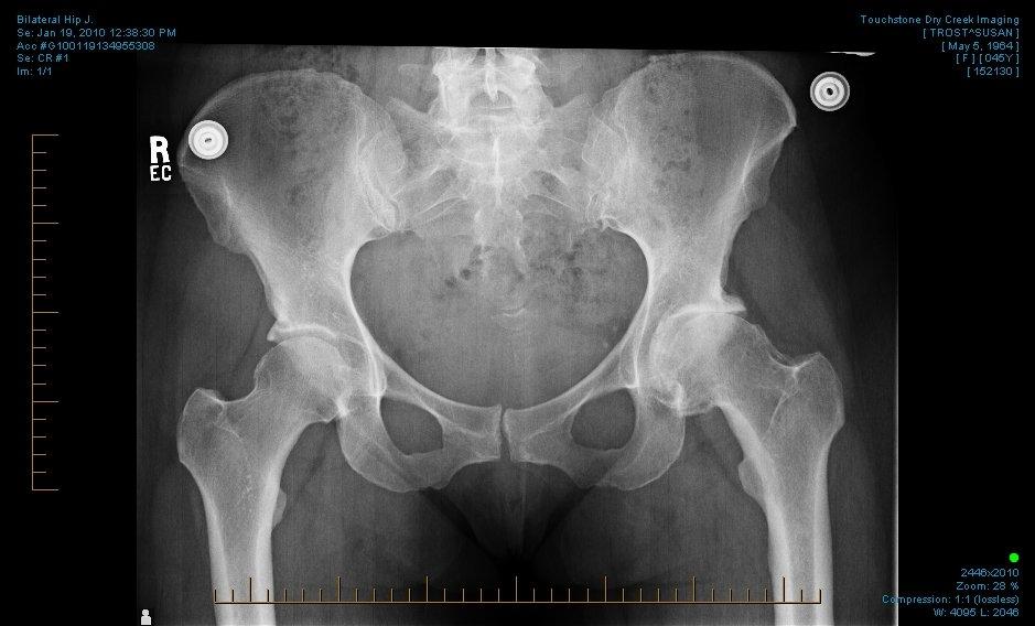 BILATERAL_HIP_J__0002